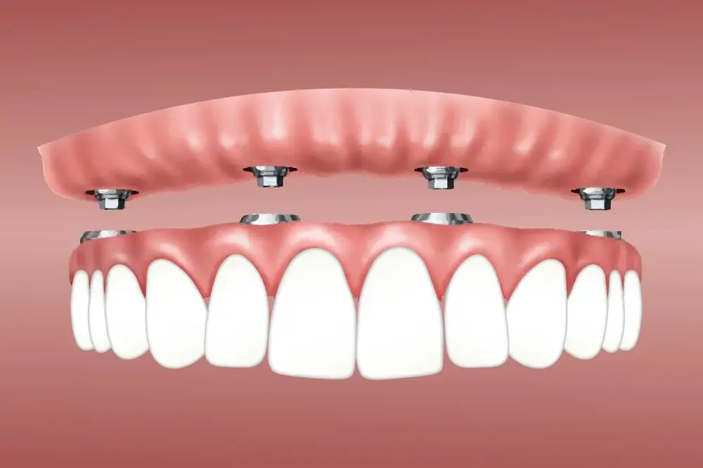 Dental Implants In Progreso Mexico